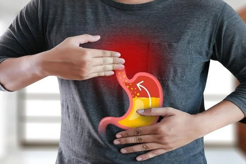 Trào ngược dạ dày - Ợ nóng, ợ chua