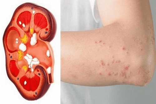 Dấu hiệu suy thận - Ý nghĩa của việc nhận biết sớm dấu hiệu