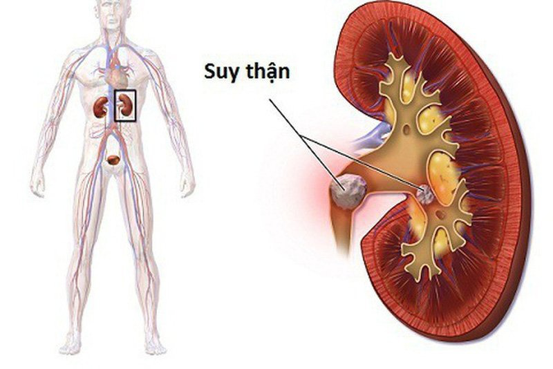 Dấu hiệu suy thận - Chế độ ăn uống khoa học