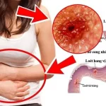 Đau Bụng Dưới Bên Trái