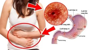 Đau Bụng Dưới Bên Trái