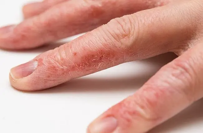 Viêm da cơ địa - Ai dễ mắc và những yếu tố liên quan Viêm da cơ địa - Ai dễ mắc và những yếu tố liên quan