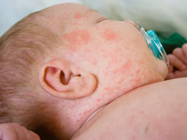 Viêm da cơ địa - Khi nào cần đi khám sớm Viêm da cơ địa - Khi nào cần đi khám sớm