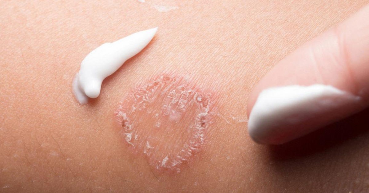 Dấu hiệu tổn thương biểu mô do vi nấm