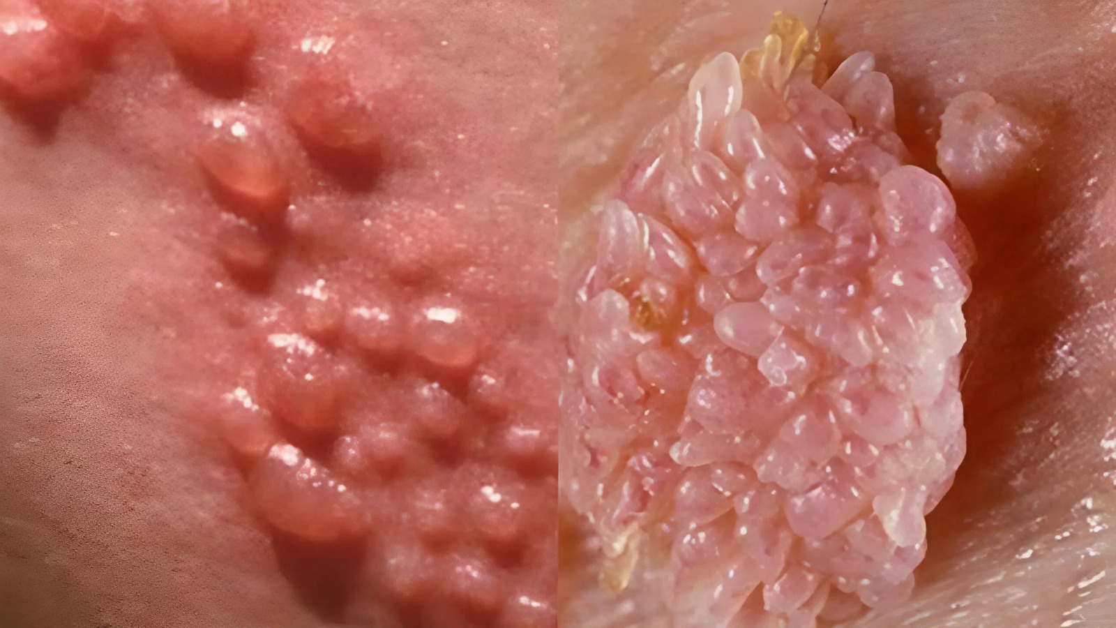 Kiến thức nền tảng về bệnh lý sùi mào gà