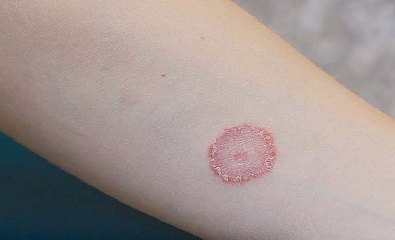 Biểu hiện lâm sàng của bệnh hắc lào thường gặp