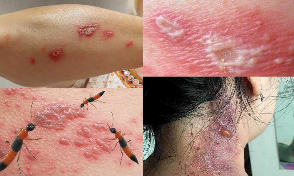 Biểu hiện lâm sàng của những tổn thương da