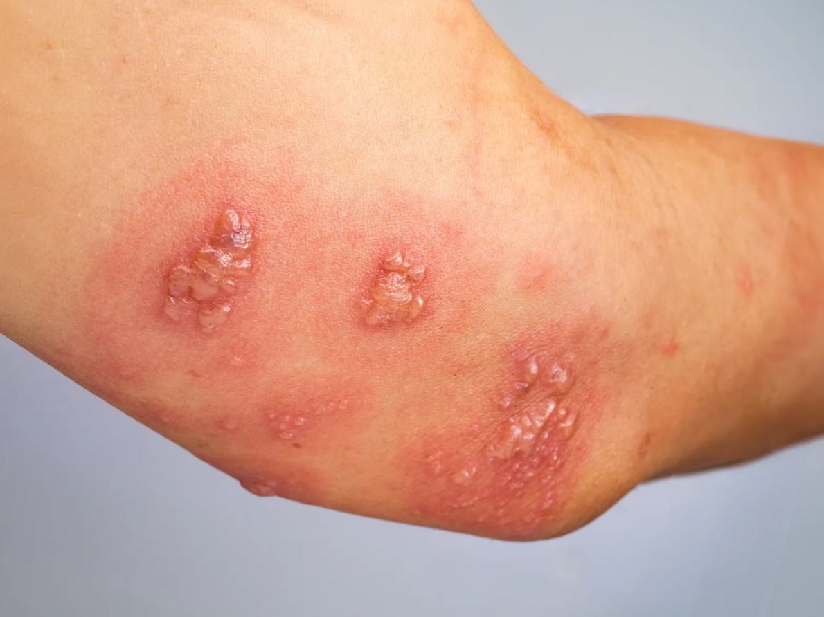 Tìm hiểu về cơ chế phát triển zona thần kinh