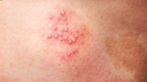 Zona Thần Kinh - 5 Lưu Ý Về Điều Trị Hiệu Quả Nhất