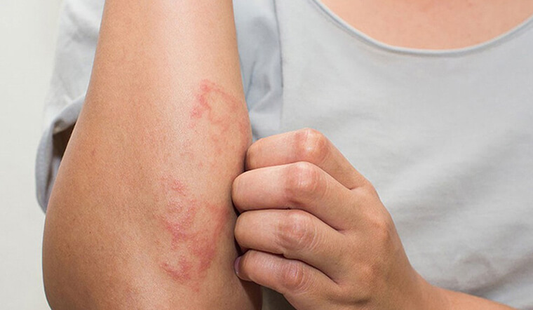 Kiến ba khoang cắn - Nhận diện và thời điểm Kiến ba khoang cắn - Nhận diện và thời điểm