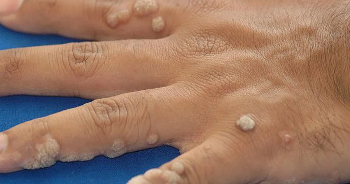 Mụn cóc - Tự điều trị: nên chọn cách nào và theo dõi ra sao