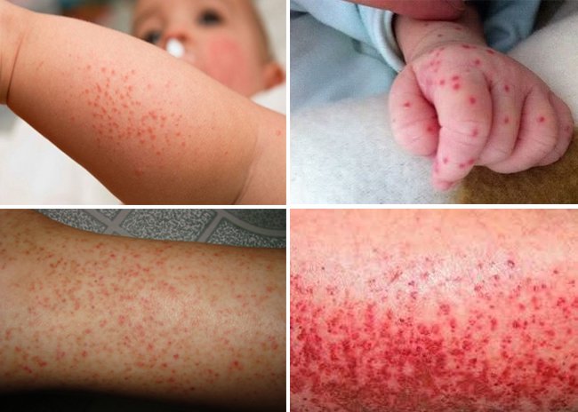 Triệu chứng sốt xuất huyết - Sốt xuất huyết không chỉ là sốt vài ngày