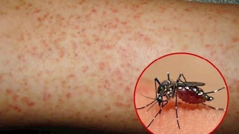 Triệu chứng sốt xuất huyết - Sốt cao đột ngột, mệt lả và đau nhức toàn thân