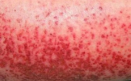 Triệu chứng sốt xuất huyết - Buồn nôn, phát ban và chấm xuất huyết