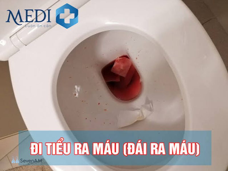 Đái ra máu - Cách phòng ngừa và chăm sóc sức khỏe tiết niệu Đái ra máu - Cách phòng ngừa và chăm sóc sức khỏe tiết niệu